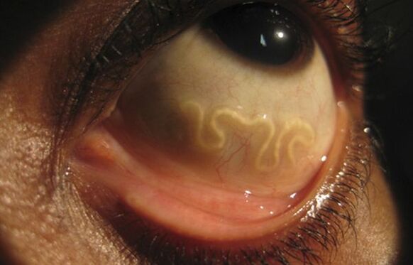 Le ver loa loa vit dans l’œil humain et provoque la cécité